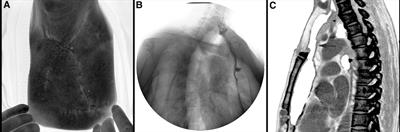 Successful cervicothoracic esophageal stricture treatment with partial sternectomy and a pedicled TAAP flap: A case report